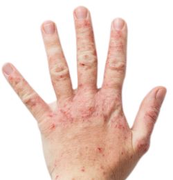 Hand with allergic contact dermatitis