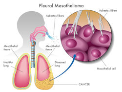 Image of how asbestos affects lungs