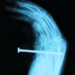 X-ray of a nail gun injury the nail has been shot into a hand