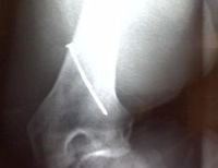 Picture of xray shows nail gun shot grazed bone inside leg