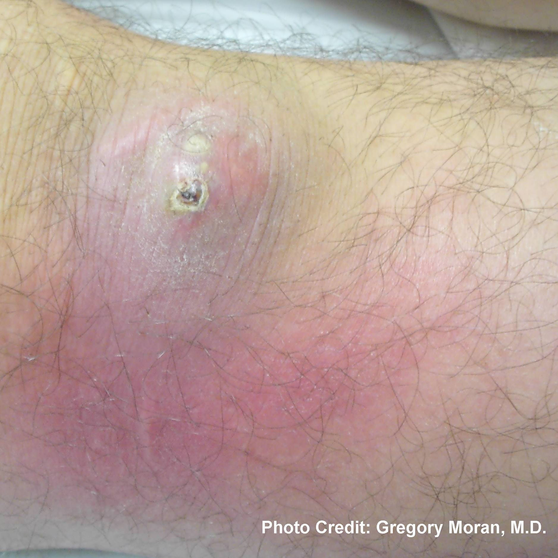 A patient with a MRSA Methicillin resistant staphylococcus aureus infection