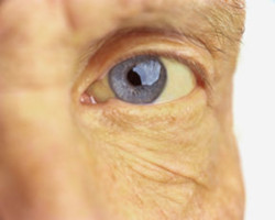 Close up picture of an yellowed eye; Person with jaundice