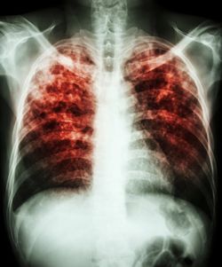 Image of X-ray for Tuberculosis