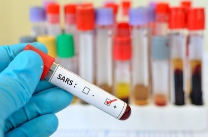 Sample vile of severe acute respiratory syndrome SARS