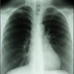 Image of lung xray.