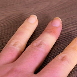 Example of white finger syndrome