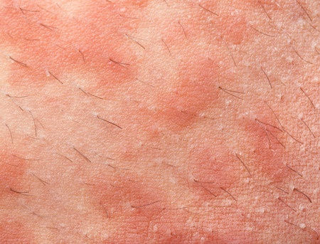 Skin of person with contact dermatitis